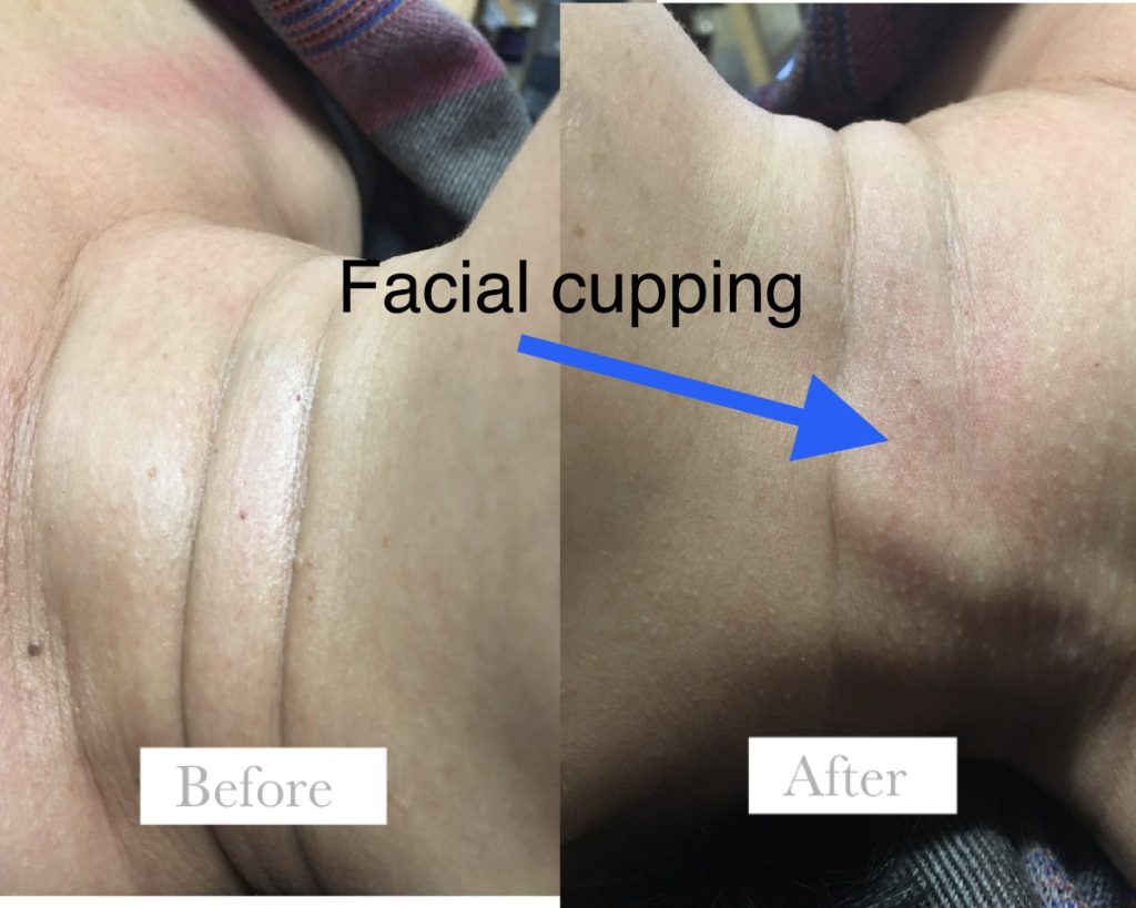 before and after facial cupping treatment photo