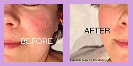 Rosacea before and after facial acupuncture treatment